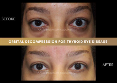 Thyroid Eye Disease Photos 8