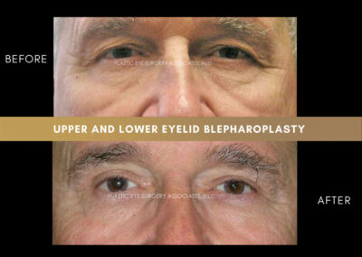Male Blepharoplasty Photos 38