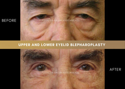 Male Blepharoplasty Photos 37