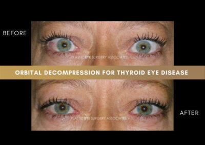 Thyroid Eye Disease Photos 49