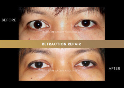 Retraction Photos 7