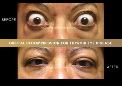 Thyroid Eye Disease Photos 50