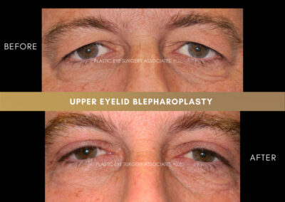 Male Blepharoplasty Photos 36