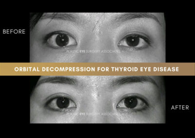 Thyroid Eye Disease Photos 51