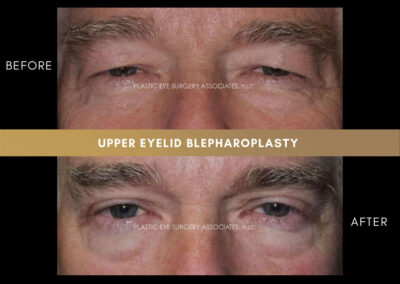 Eyelid Reshaping Photos 120