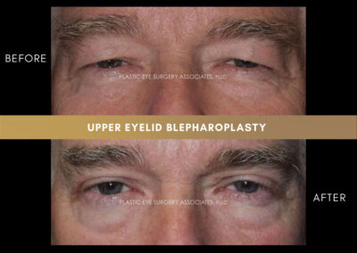 Male Blepharoplasty Photos 35