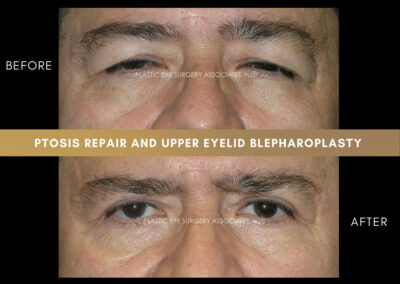 Male Blepharoplasty Photos 34