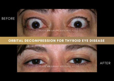 Thyroid Eye Disease Photos 52