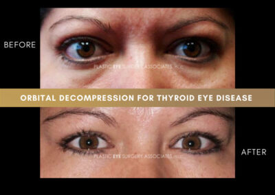 Thyroid Eye Disease Photos 53