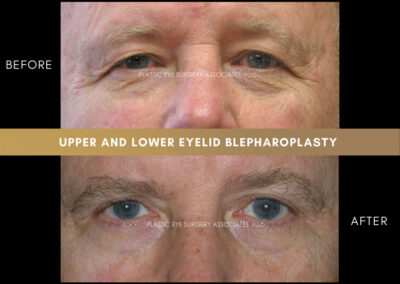 Lower Blepharoplasty Photos 13