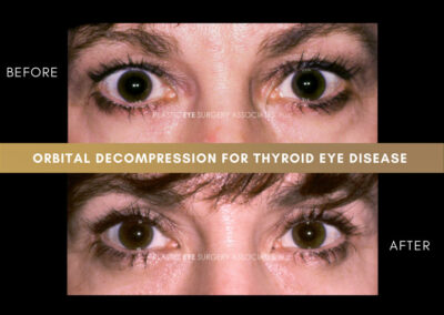 Thyroid Eye Disease Photos 54