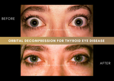 Thyroid Eye Disease Photos 1