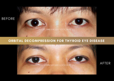 Thyroid Eye Disease Photos 2