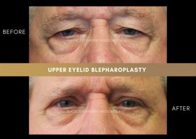 Upper Eyelid Aesthetics Photos 2