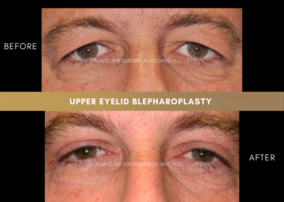 Upper Eyelid Aesthetics Photos 5