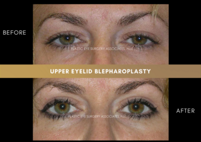 Upper Eyelid Aesthetics Photos 3