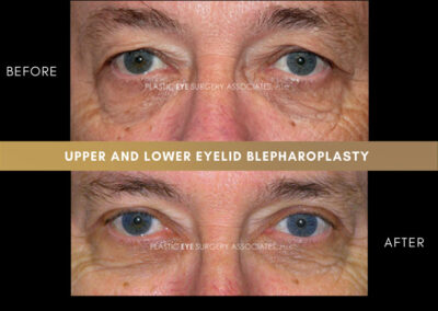 Male Blepharoplasty Photos 26