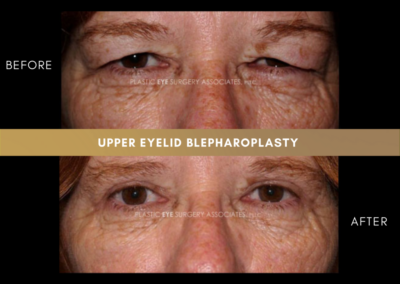 Upper Eyelid Aesthetics Photos 4