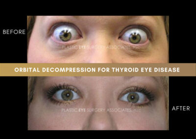 Thyroid Eye Disease Photos 10