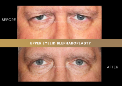 Upper Eyelid Aesthetics Photos 6