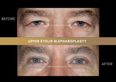 Eyelid Reshaping Photos 130