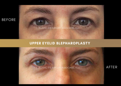Upper Eyelid Aesthetics Photos 7