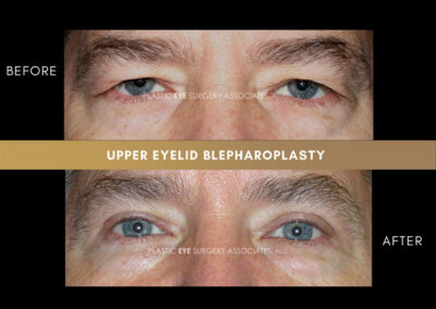 Male Blepharoplasty Photos 25