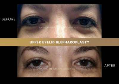 Upper Eyelid Aesthetics Photos 8