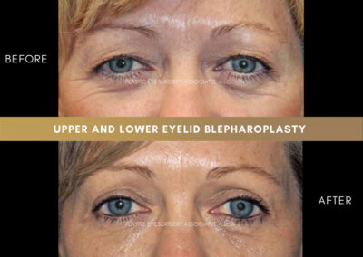 Lower Blepharoplasty Photos 14