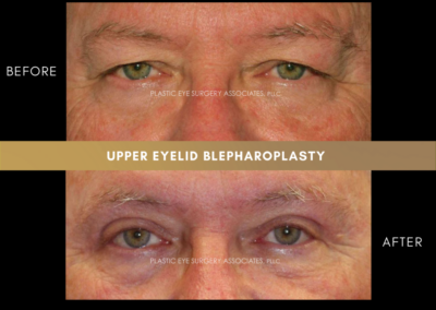 Upper Eyelid Aesthetics Photos 10