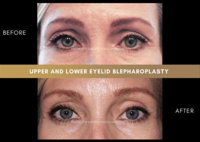 Lower Blepharoplasty Photos 15
