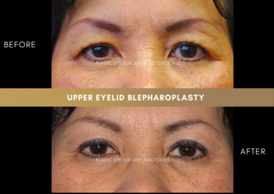 Upper Eyelid Aesthetics Photos 11