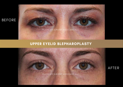 Upper Eyelid Aesthetics Photos 12