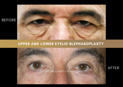 Male Blepharoplasty Photos 24
