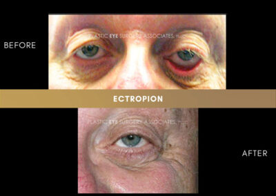 Ectropion/Entropion Photos 8