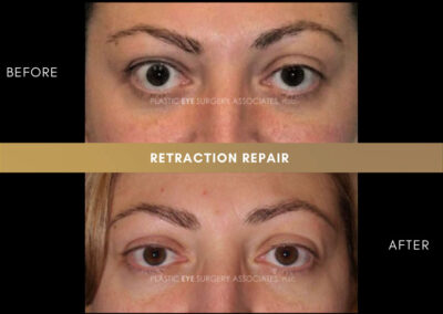 Retraction Photos 16
