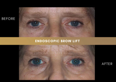 Corrective plastic surgery photos 2