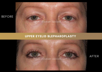Upper Eyelid Aesthetics Photos 14