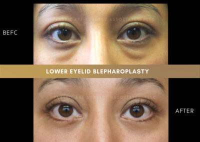 Lower Blepharoplasty Photos 18