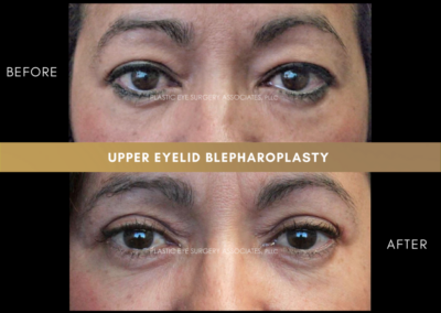 Upper Eyelid Aesthetics Photos 15