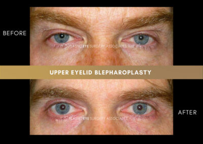 Male Blepharoplasty Photos 23