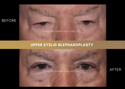 Upper Eyelid Aesthetics Photos 16