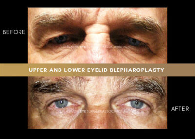 Male Blepharoplasty Photos 22