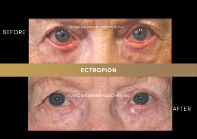 Ectropion/Entropion Photos 10