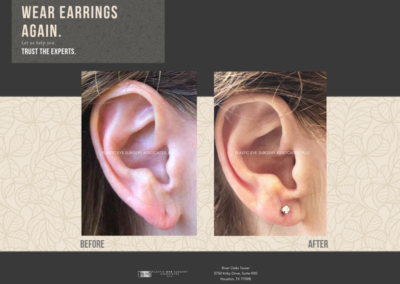 Before & After Earlobe Surgery 1