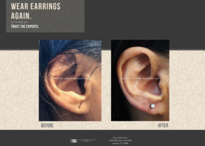 Before & After Earlobe Surgery 2