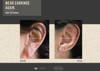 Before & After Earlobe Surgery 3