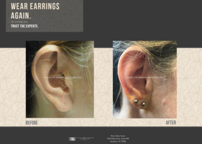 Before & After Earlobe Surgery 4