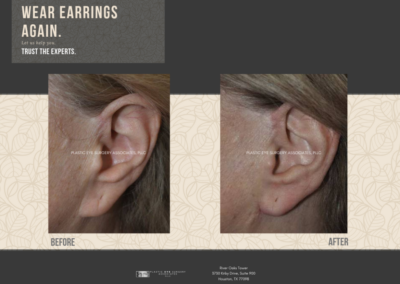 Before & After Earlobe Surgery 5