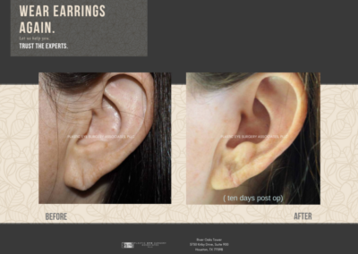 Before & After Earlobe Surgery 6